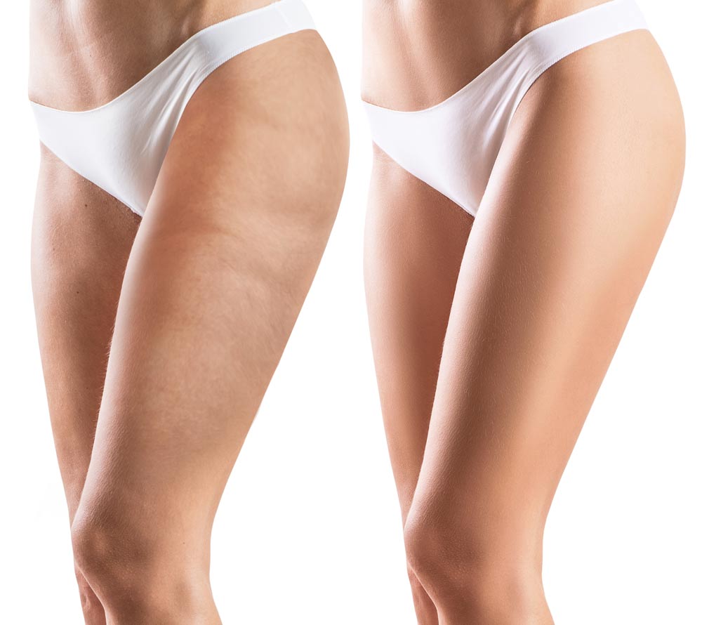 cellulite plateforme vibrante